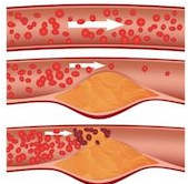 Risico op aderverkalking lager bij matige alcoholconsumptie